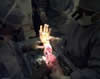 Hand Transplant