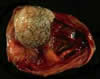 Tumor Sa Obaryo